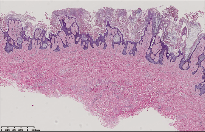 Hyperkeratosis in the resected area (haematoxylin and eosin, ×20)