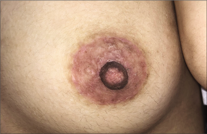 Follow-up at six months shows a natural appearance without obvious scars or disease recurrence