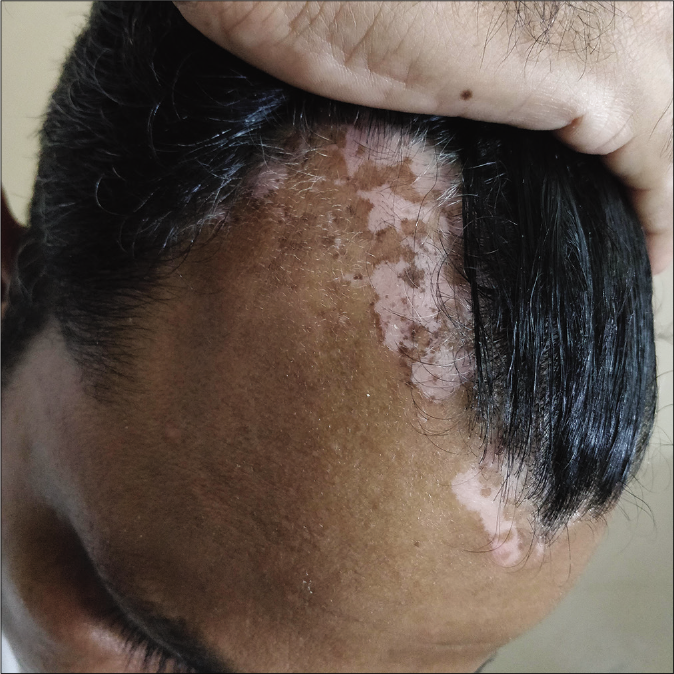 Depigmented patches of vitiligo over face at baseline