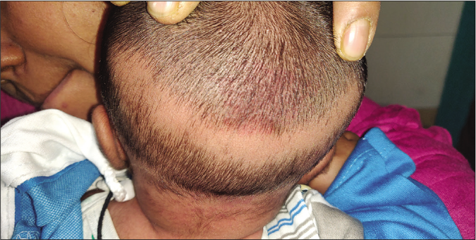 Elongated oval patch of alopecia on the occiput of a neonate