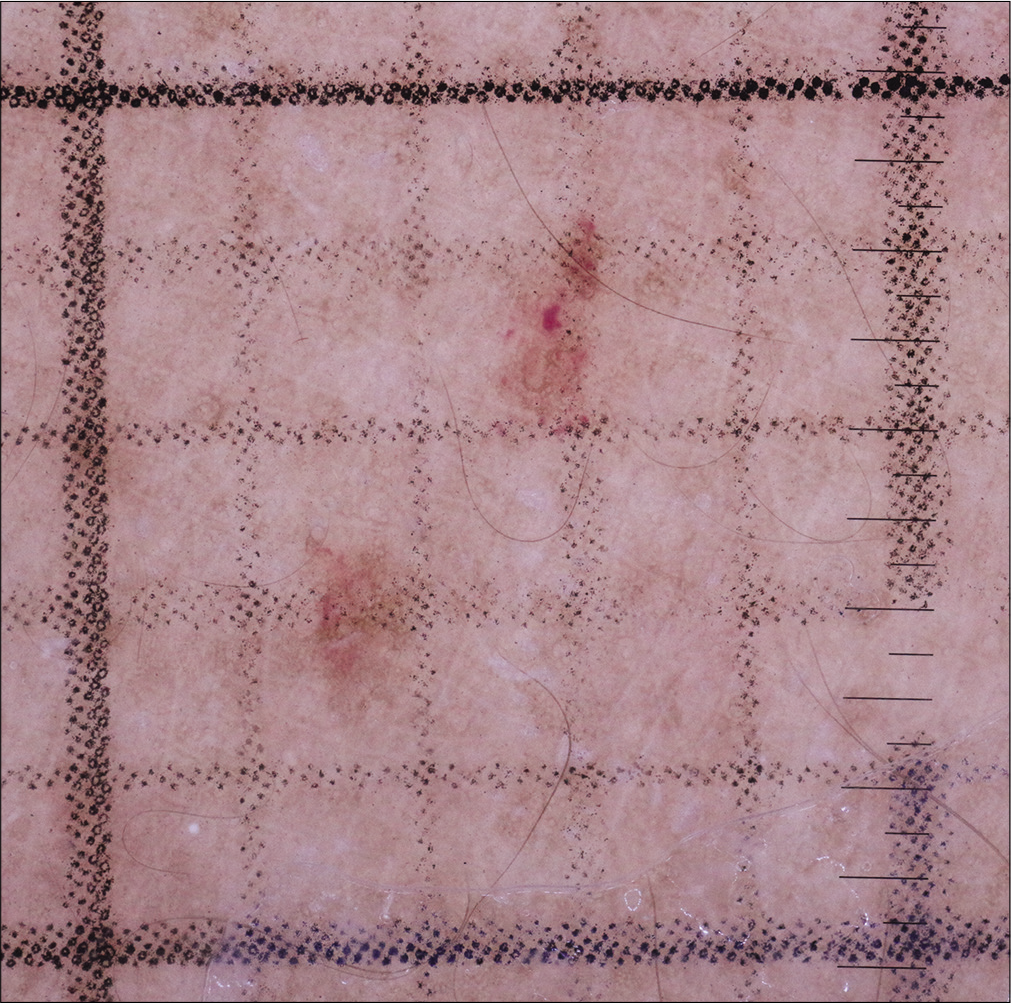 Grid used for lesional area measurement (each small square in the grid has a side of 2 mm)