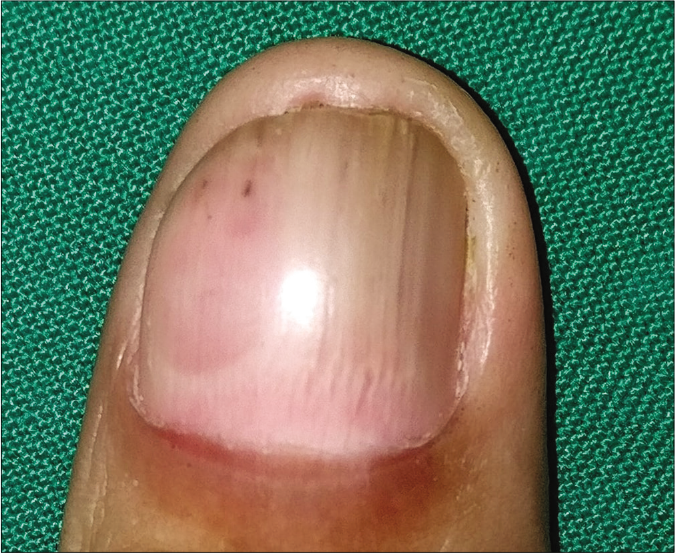 A pinkish nodular swelling covering approximately medial one-third of the right thumb