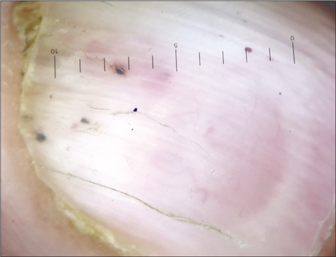 Dermoscopy of the lesions showing a pinkish white homogenous patch with defined margins in the center along with peripheral radiating whitish streaks; the curved and branching vessels are seen in the center as well as between the radiating white streaks. (DermLite DL4, polarizing, 10×)