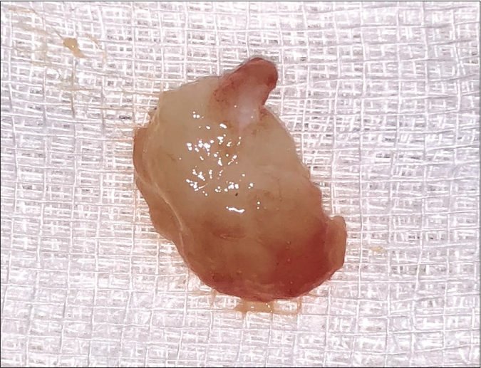 An excised flesh colored to yellowish nodule of size 1.3 cm × 1 cm with smooth surface
