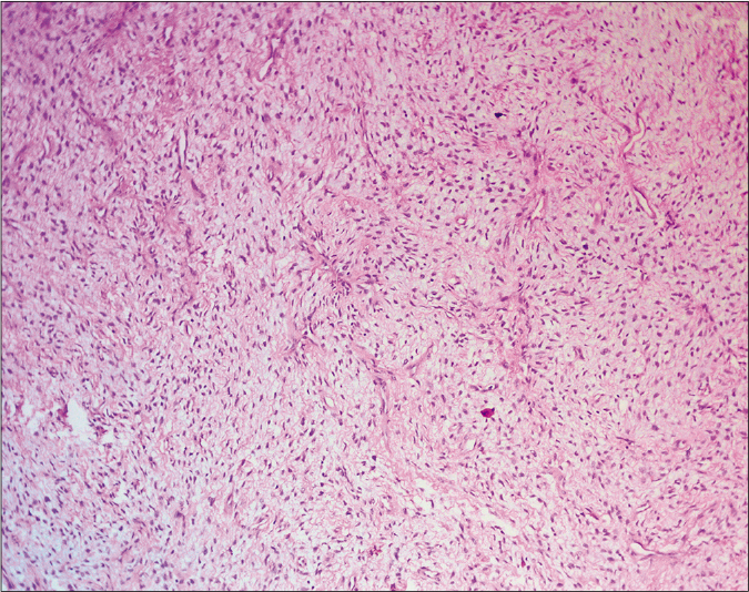 A moderately cellular spindle cell tumor with myxoid stroma (H and E, 40×)