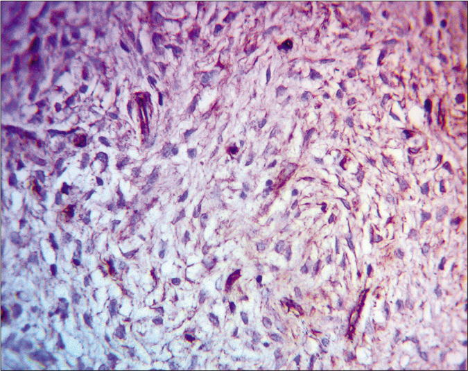 Tumor cells positive for CD34 (IHC, ×400)
