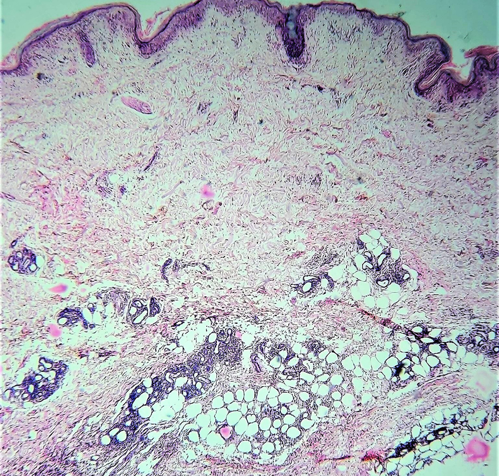 Lobular panniculitis showing infiltrate around the subcutaneous fat cells (Haematoxylin and eosin, ×40)