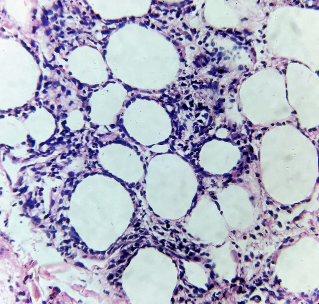 Lobular panniculitis showing predominantly lymphocytic infiltrate around the subcutaneous fat cells (Haematoxylin and eosin, ×400)