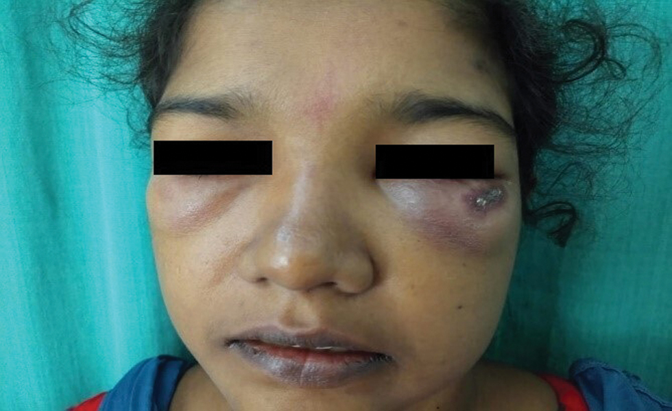 Bilateral periorbital erythema and oedema with an ulcer on the left infraorbital area