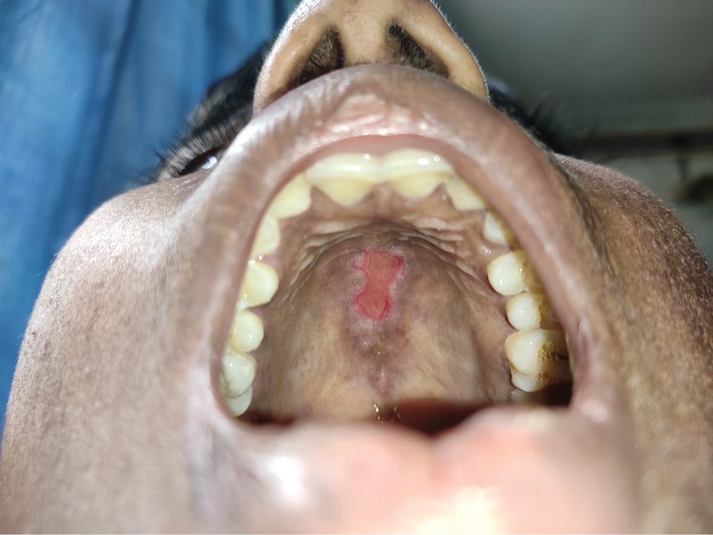 Erythema and erosion on hard palate