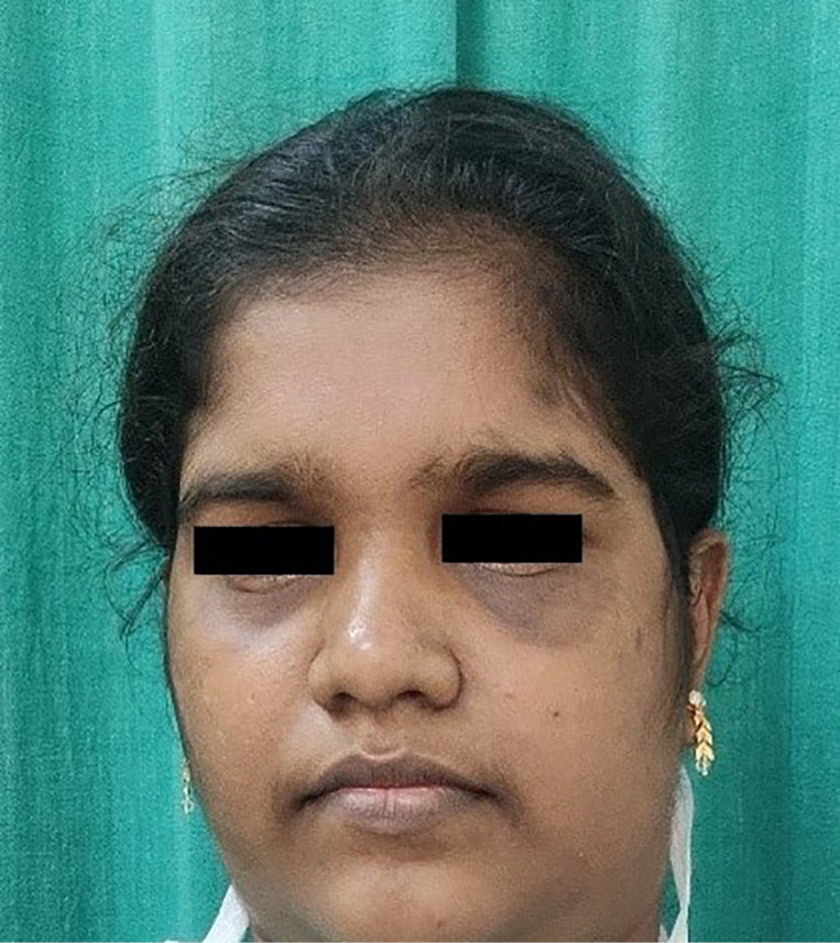 Bilateral periorbital post-inflammatory hyperpigmentation