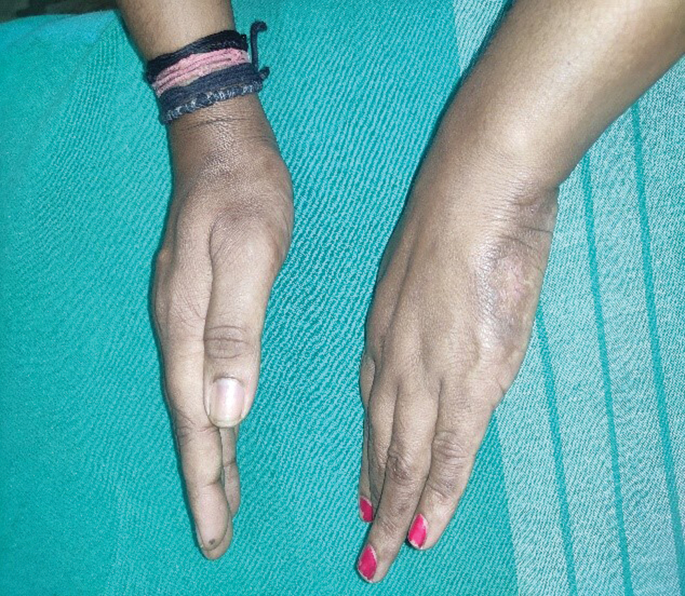 Post-inflammatory hyperpigmentation following subsidence of cutaneous ulcers on the sides of both hands