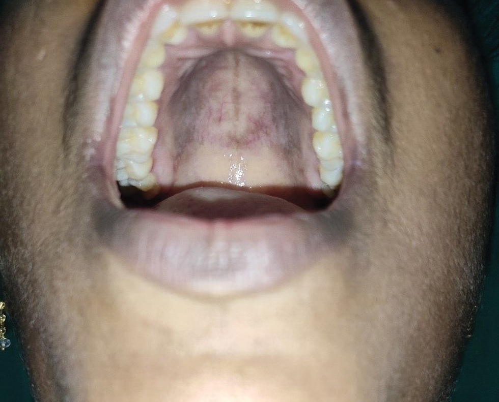 Post-inflammatory hyperpigmentation on the hard palate