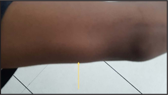 Swelling on medial aspect of left upper arm, a few centimetres proximal to elbow joint (yellow arrow)