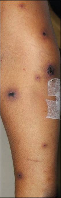 Multiple dull erythematous papules and plaques with dusky necrotic centre and a few with central vesicle/bulla on right forearm