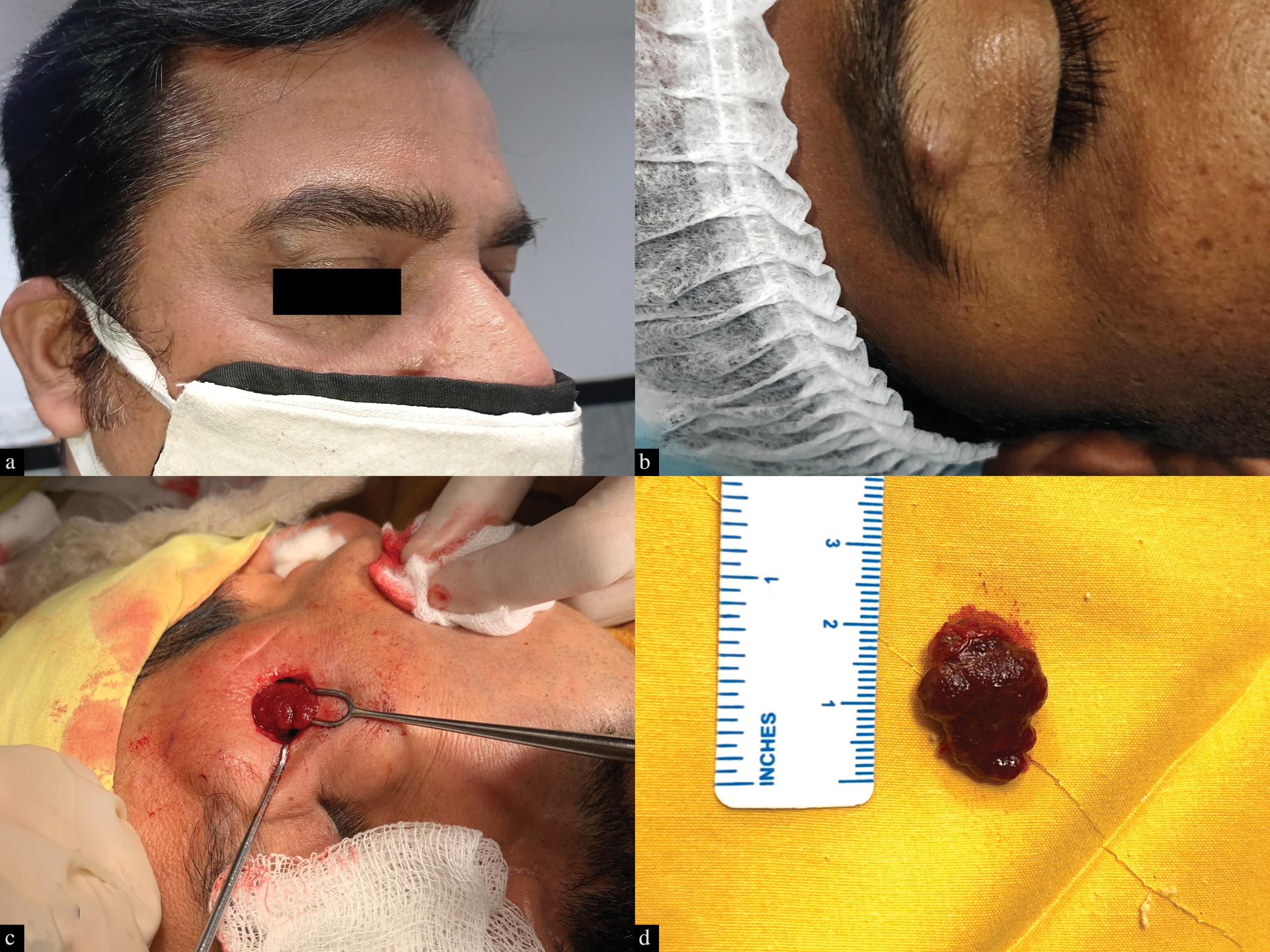 Venous malformations at peri-ocular area in adults mimicking epidermoid cysts. (a) Swelling in the upper eyelid just beneath the eyebrow in Patient 1, with a bluish-hue. (b) A nearly identical presentation in Patient 2, along with a ‘pseudo-punctum’. Grossly dark haemorrhagic lesion seen intra-operatively (c) and after excision (d) in Patient 3.