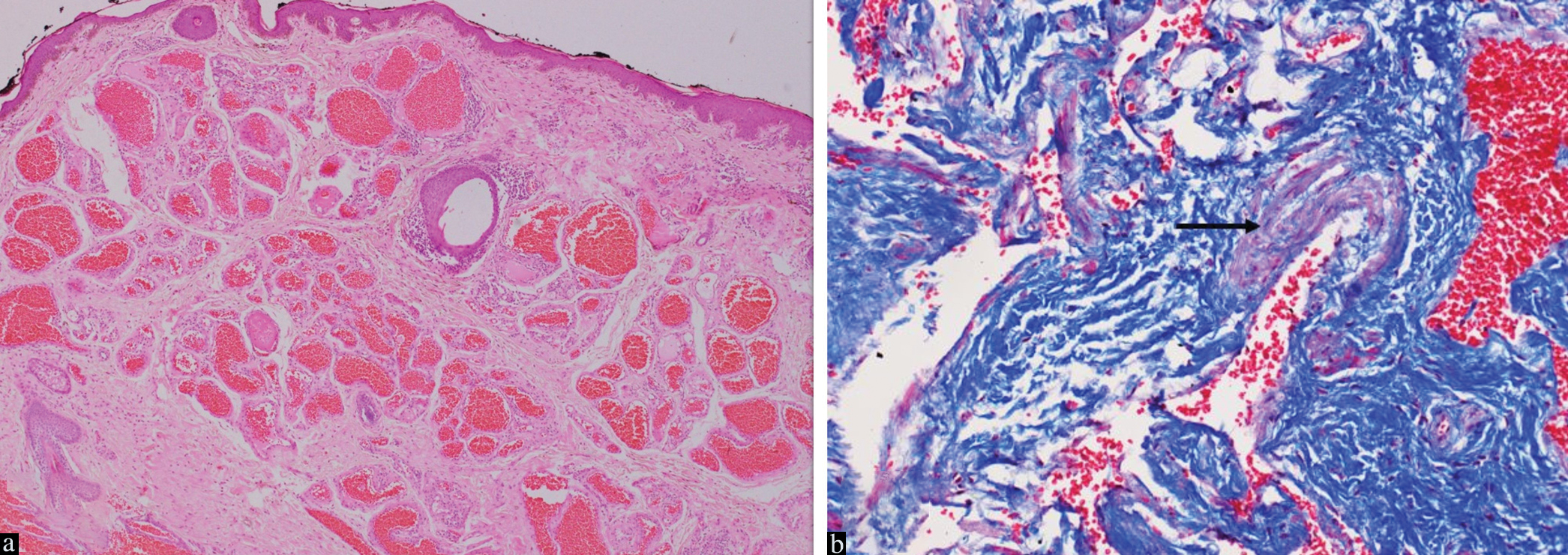 Histopathology of cavernous haemangioma type of venous malformation. (a) Multiple large endothelial-cell lined spaces are congested with erythrocytes throughout the dermis. Haematoxylin and eosin, magnification × 400. (b) Myocytes in the wall, implying a venous component, in one of the specimens. Masson’s trichrome, magnification × 1000.