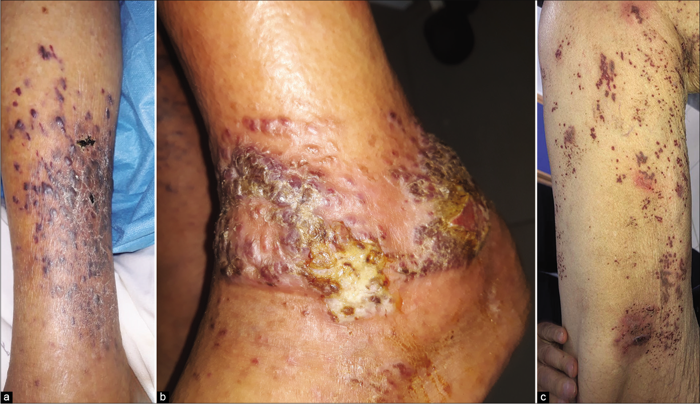 (a) Purple and dusky erythematous papules, plaques and nodules of Kaposi’s sarcoma on the right leg, (b) Kaposi’s sarcoma manifesting as purple and erythematous papules and plaques with scaling and ulceration, (c) Purple papules of Kaposi’s sarcoma on the right thigh