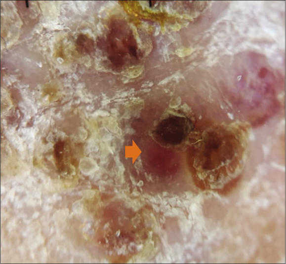 Dermoscopy of a nodular lesion of Kaposi’s sarcoma showing nodular lesion with peripheral scales {orange arrow} (3Gen DermLite III DL3N, polarised light, ×10)