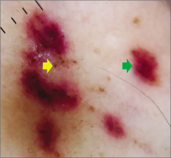 Dermoscopy of a nodular lesion of Kaposi’s sarcoma showing small brown globules {yellow arrow} and purple-pink colouration {green arrow} (3Gen DermLite III DL3N, polarised light, ×10)