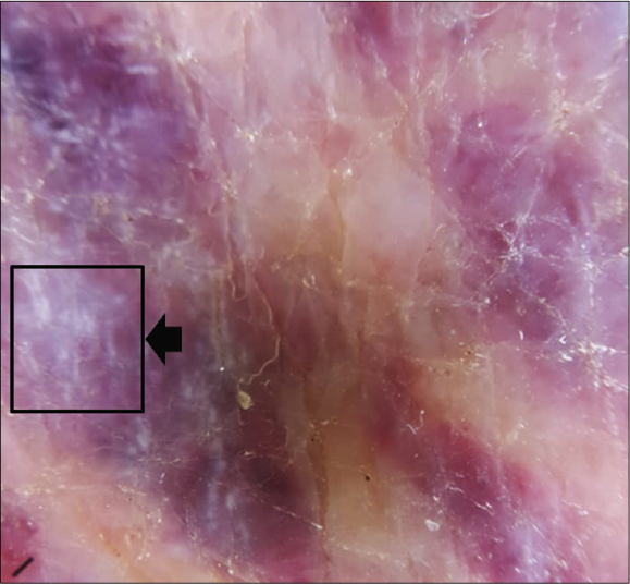 Dermoscopy of a nodular lesion of Kaposi’s sarcoma showing rainbow pattern {black arrow} (3Gen DermLite III DL3N, polarised light, ×10)