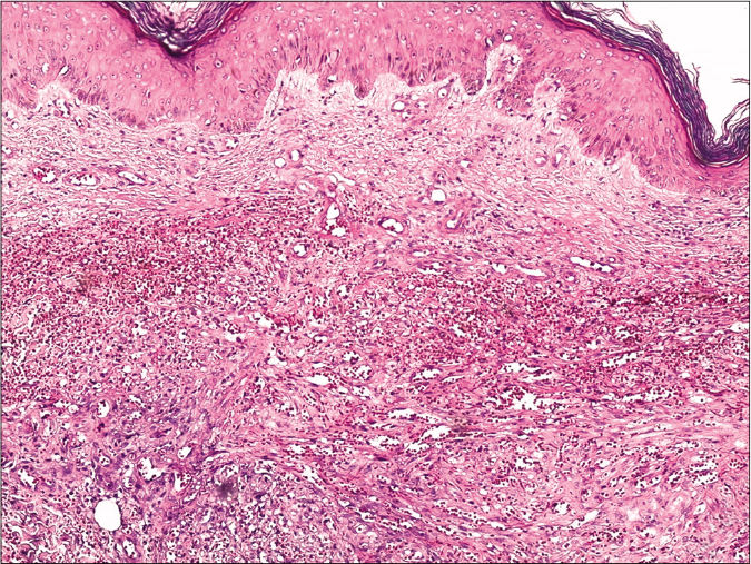 Skin biopsy from a nodule of Kaposi’s sarcoma on the right leg showing circumscribed proliferation of spindle cells arranged in fascicles and slit-like vascular channels (H and E, ×50)