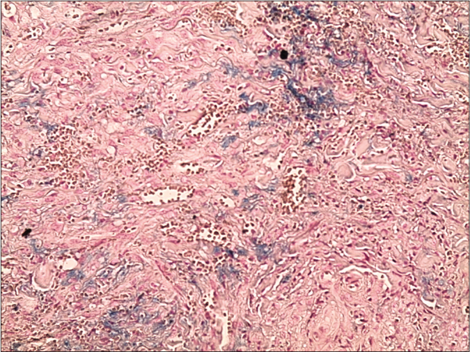 Skin biopsy from a nodule of Kaposi’s sarcoma on the right leg showing circumscribed proliferation of spindle cells arranged in fascicles, slit-like vascular channels and extravasation of erythrocytes (Perl’s stain, ×200)