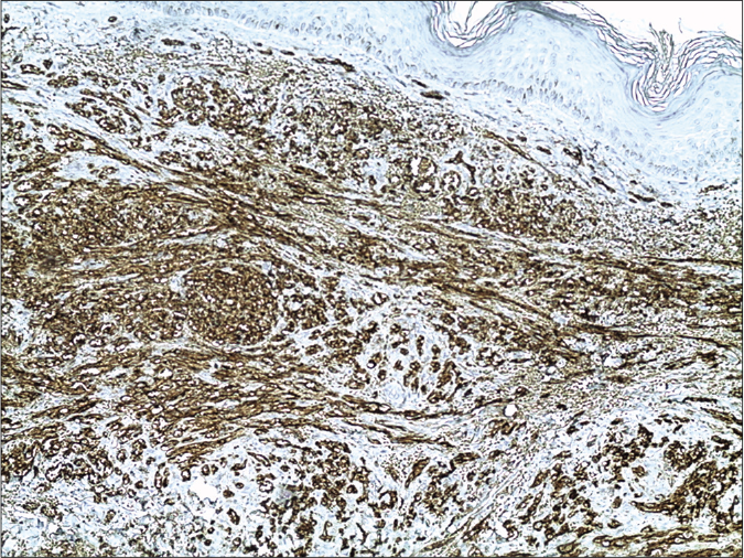 The nuclei of the tumour cells of Kaposi’s sarcoma demonstrating immunoreactivity for CD31 (13B10 clone ×200)