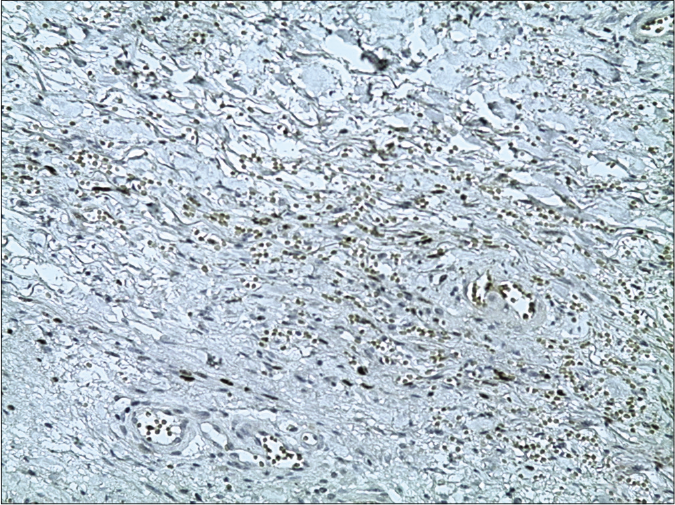 The nuclei of the tumour cells of Kaposi’s sarcoma demonstrating immunoreactivity for latent nuclear antigen-1 of human herpesvirus-8 (13B10 clone, latent nuclear antigen-1 of human herpesvirus-8, ×200)