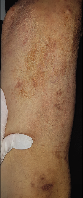 Clinical images after treatment: Regression of Kaposi lesions of the right thigh