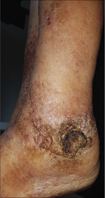 Clinical images after treatment: Partial regression of Kaposi lesions of the left ankle