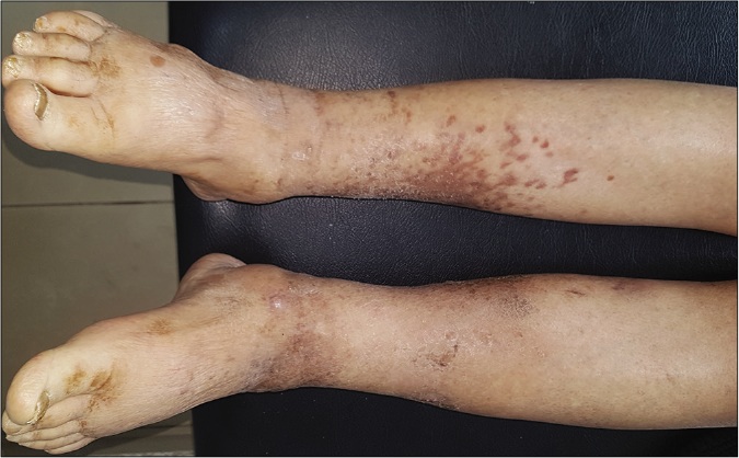 Clinical images after treatment: Partial regression of Kaposi lesions of the right leg