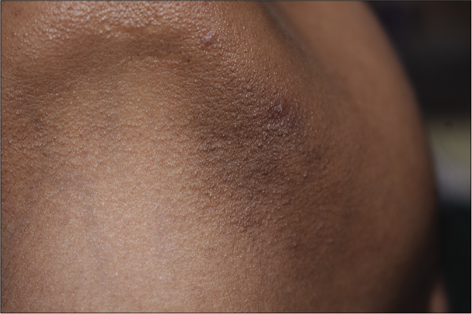 Multiple tiny, closely aggregated follicular papules involving the left jawline, at the baseline