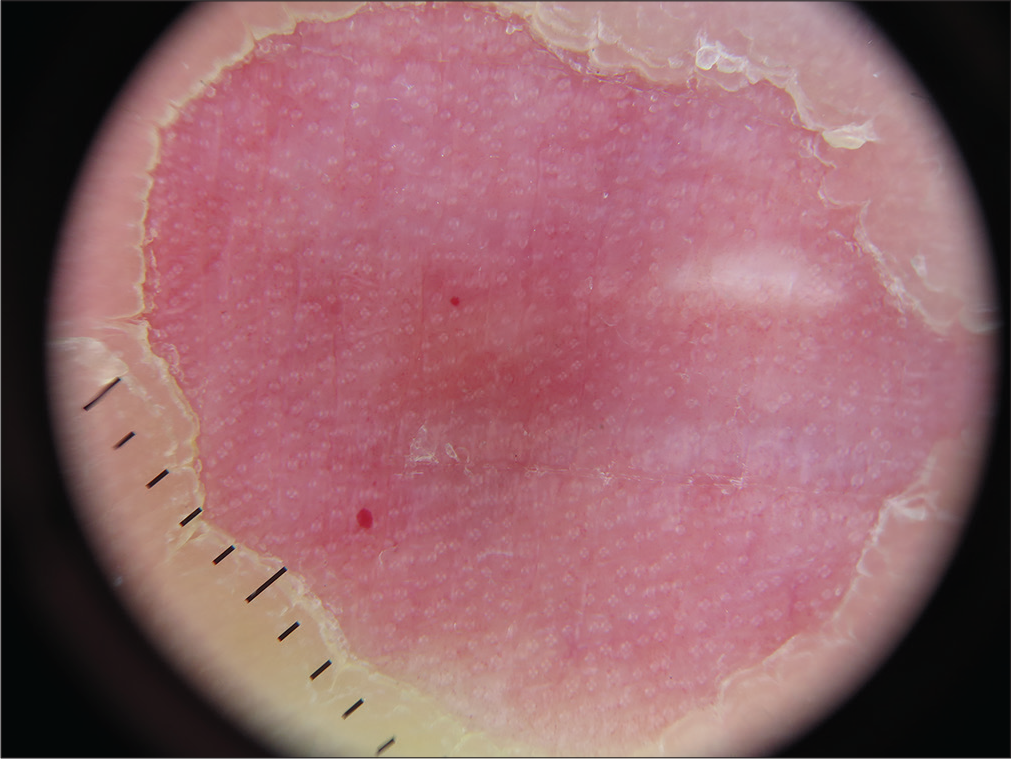 Circumscribed acral hypokeratosis: regularly distributed white rosettes in a pink background (Dermlite DL200 HR polarized light mode, ×10)