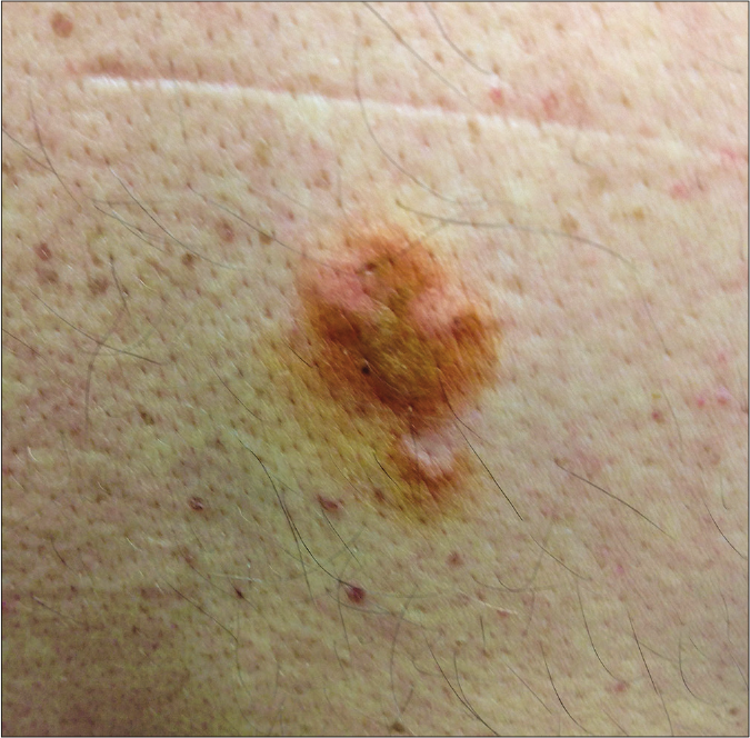 An orange-brown plaque affecting a country man’s back