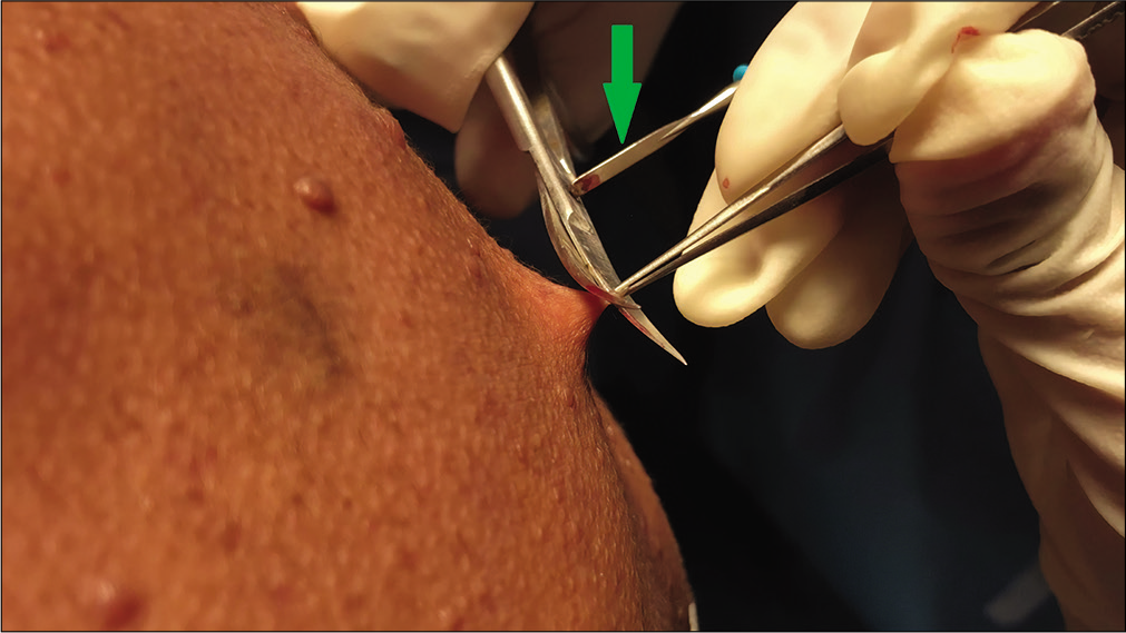 Resection of neurofibroma using electromechanical resection technique. The scissors resection is done while the electrosurgical probe (green arrow) is touched to the scissors to achieve completely bloodless resection