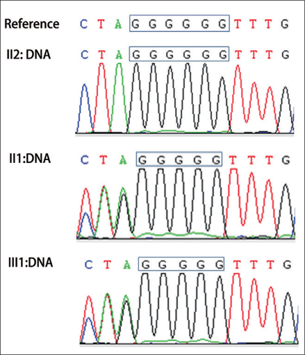 Sequence of genomic DNA, showing c.62-1 (IVS2) delG in proband (III: 1) and his mother (II: 1)