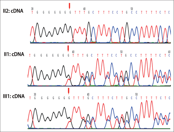 Sequence of genomic cDNA, showing c.60_66.del G variant in proband (III: 1) and his mother (II: 1)