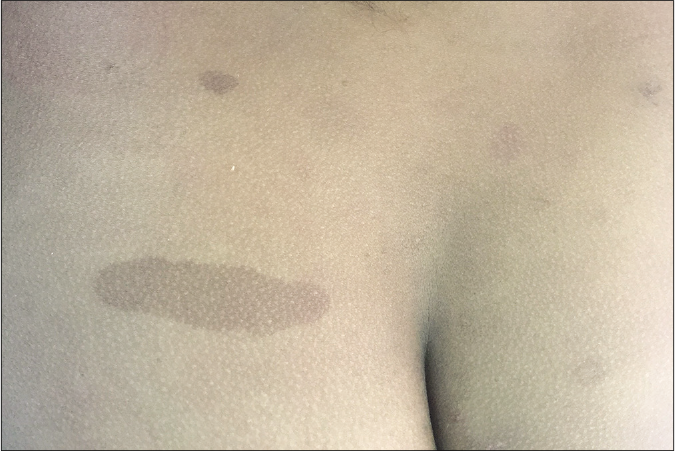 Light brown colour and regular borders of café au lait macules in neurofibromatosis type 1