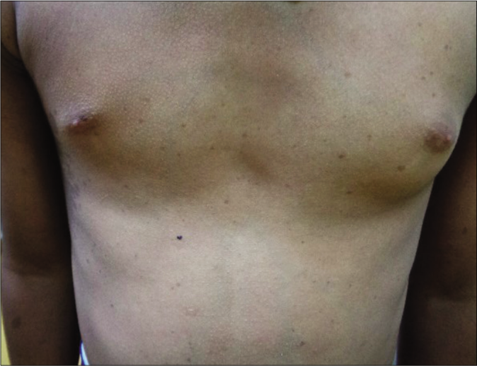 Widely-spaced nipples in a boy with suspected Noonan syndrome