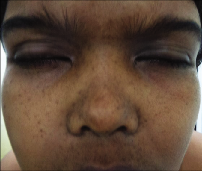 Hypertelorism in a boy with suspected Noonan syndrome with multiple lentigines
