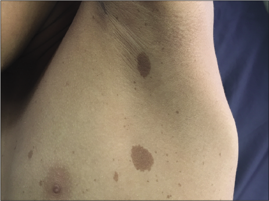 Multiple cafe au lait macules and axillary freckling in an adolescent boy with suspected Legius syndrome.