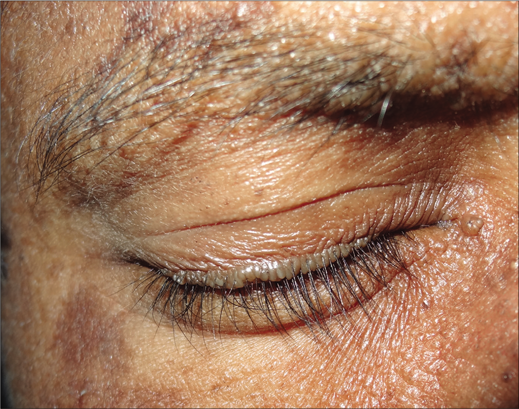 Row of waxy, yellow–white, beaded papules along the margin of the upper eyelid