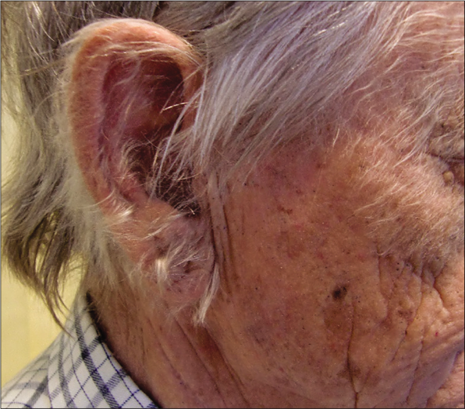 Acquired paraneoplastic hypertrichosis. The appearance of fine hair on the forehead and pinna