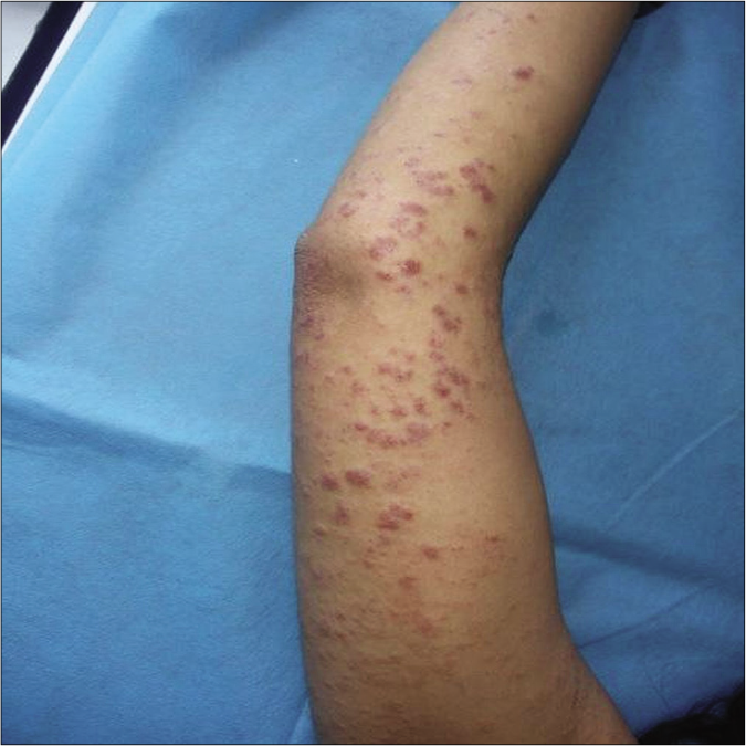 diffuse erythematous rash