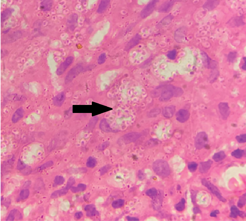 Plenty of parasitized macrophages in dermis (arrow) (H & E, ×100)