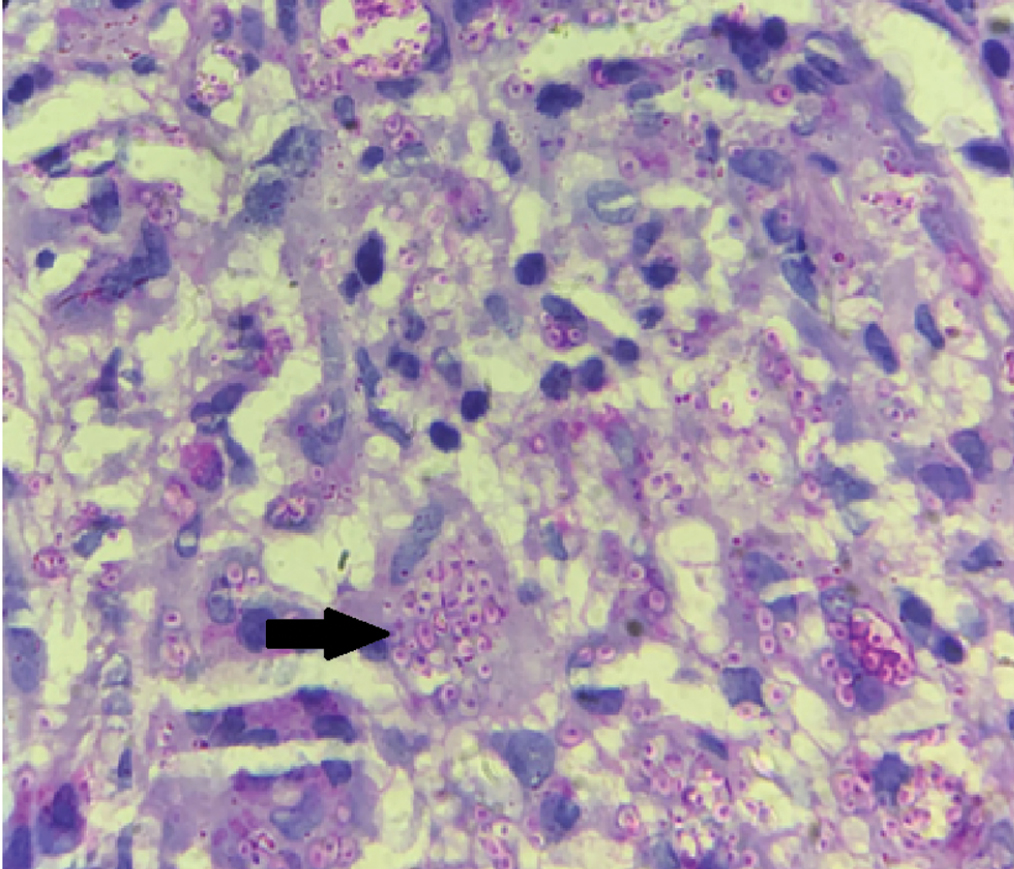 Periodic acid Schiff positive organisms within the macrophages with perinuclear halo (arrow) (PAS stain, ×100)