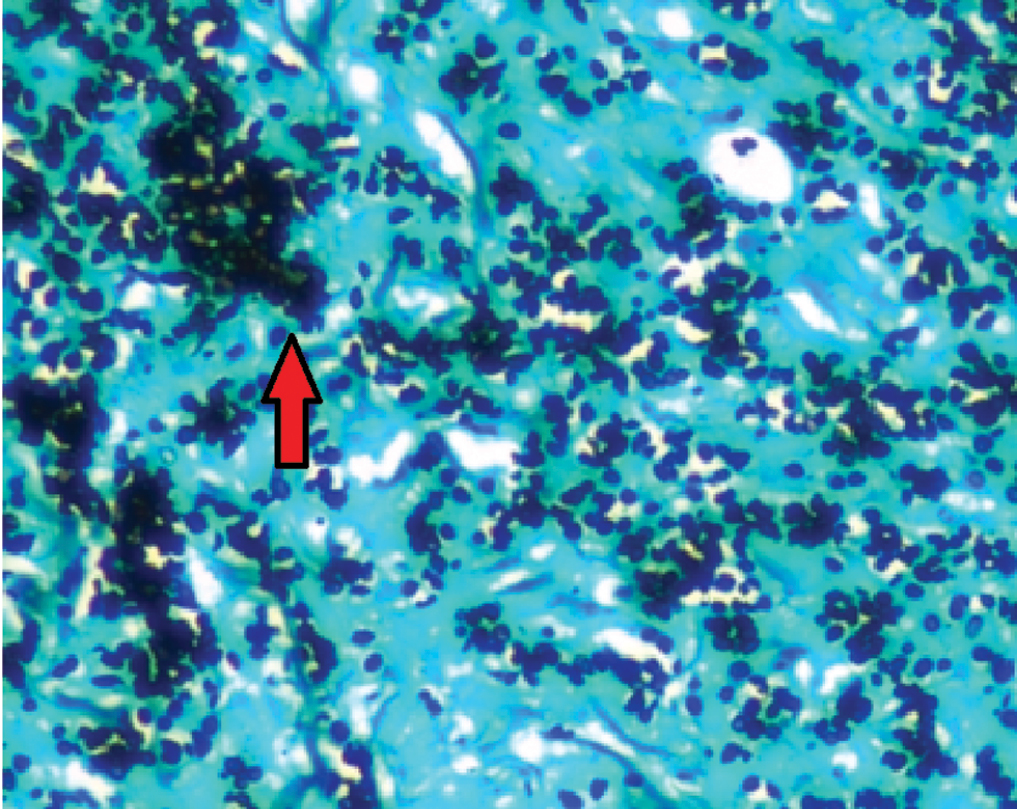 Gomori’s methenamine silver stain showing yeast forms (arrow) (GMS stain, ×100)