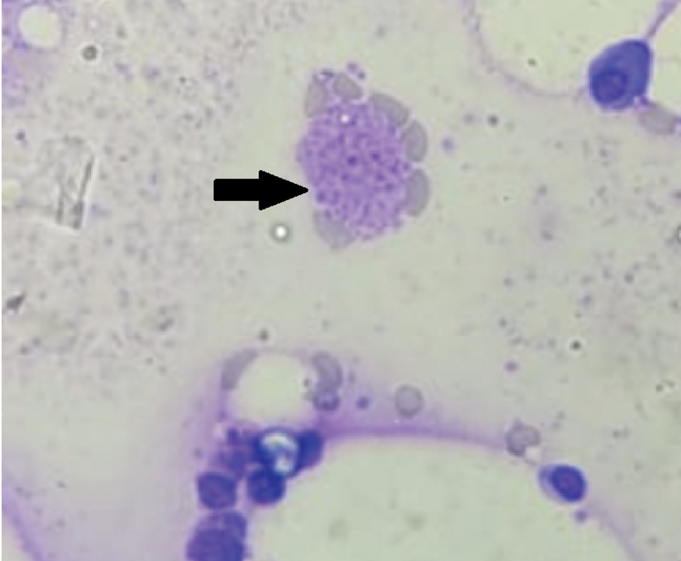 Bone marrow aspirate smear showing macrophages with yeast like organisms (arrow) (Giemsa stain, ×100)