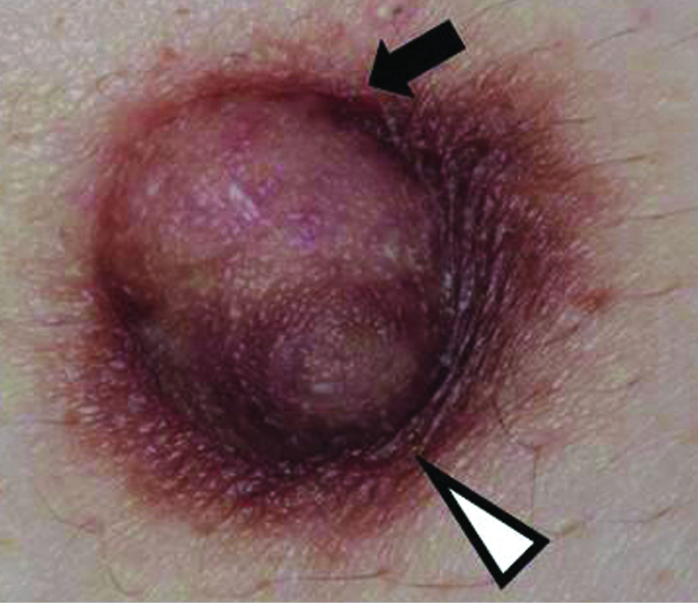 The white arrowhead and black arrow indicate the left nipple and nodule, respectively